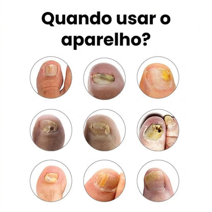 Aparelho laser portátil para a limpeza de unhas com micose, com ecrã digital e alimentação USB