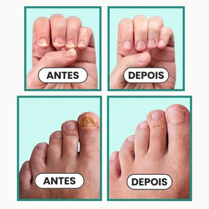 Aparelho laser portátil para a limpeza de unhas com micose, com ecrã digital e alimentação USB